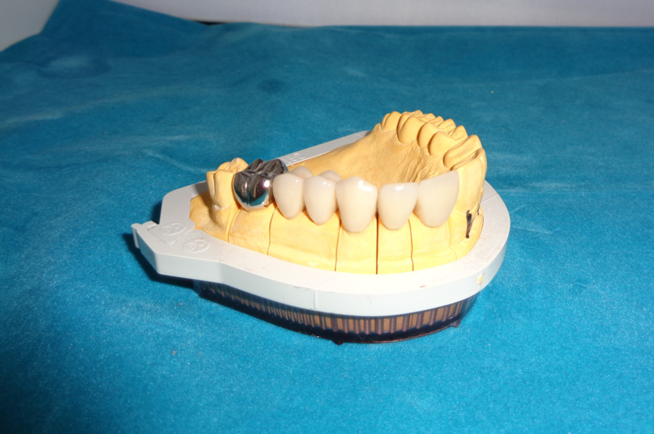 Zahnersatz für verloren Zähne